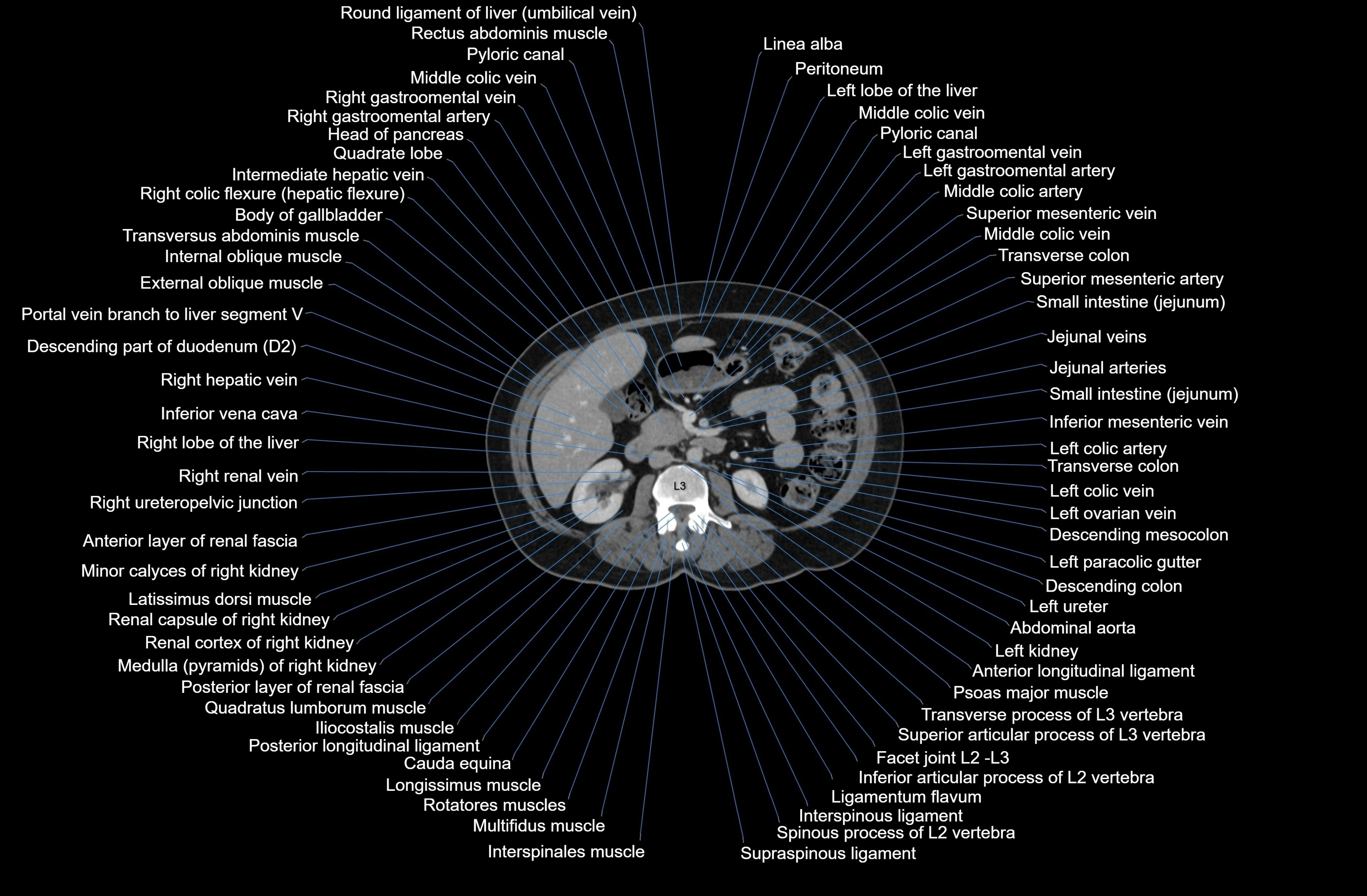 CT Abdomen axial cross sectional anatomy labelled radiology image-00040.webp